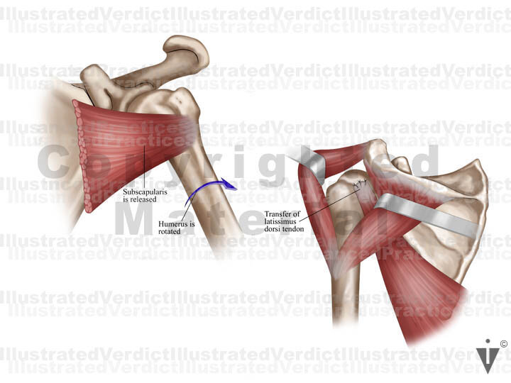 BOARD 15 1. Subscapularis is released, humerus is rotated 2. Transfer of latissimus dorsi tendon