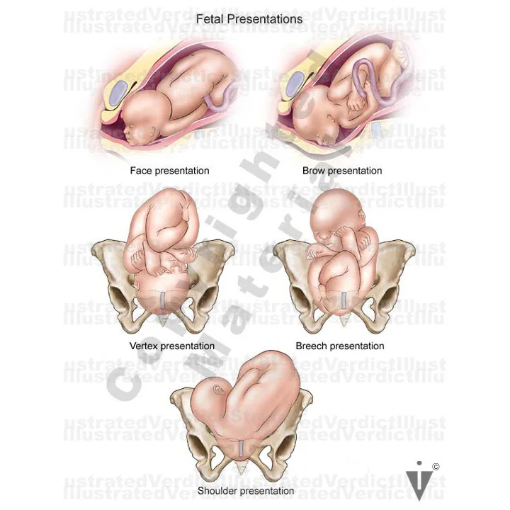 Stock Pregnancy Delivery Breech Presentation And Malposition stock-pregnancy-delivery-breech-presentation-and-malposition
