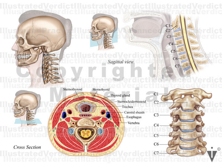 Stock Spine: Cervical Spine — Illustrated Verdict