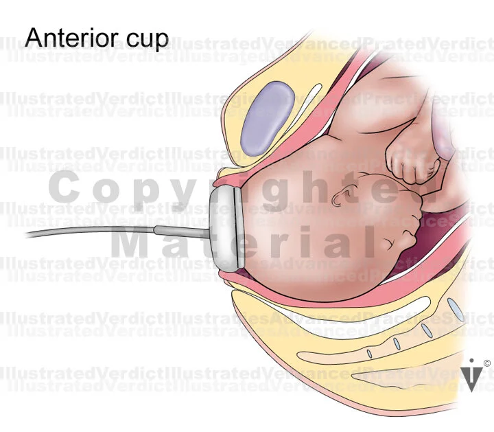 Stock Pregnancy / Delivery Vacuum / Forceps — Illustrated Verdict