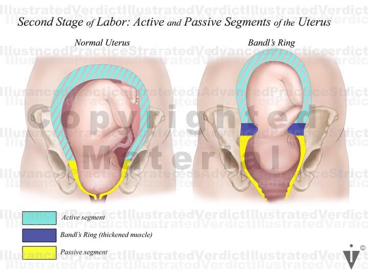 Retraction Ring | PDF | Childbirth | Uterus