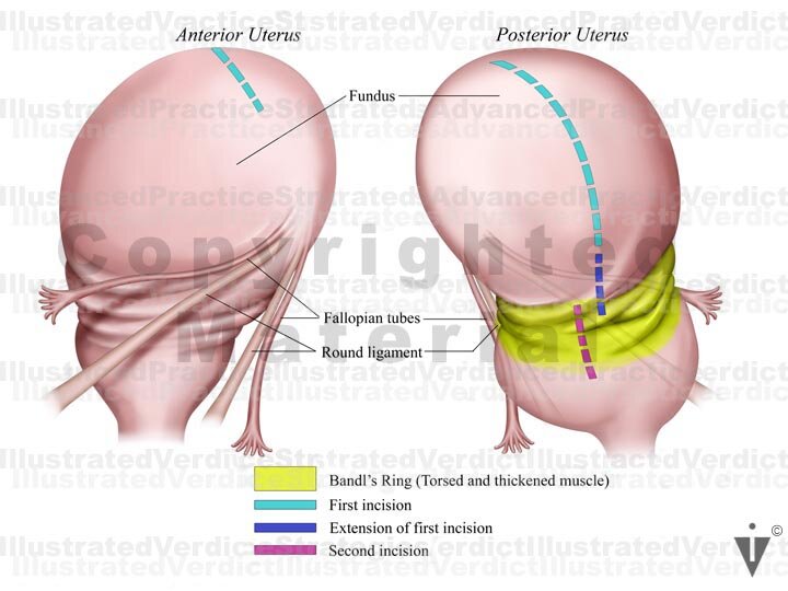 Obstetric fistula - Wikipedia