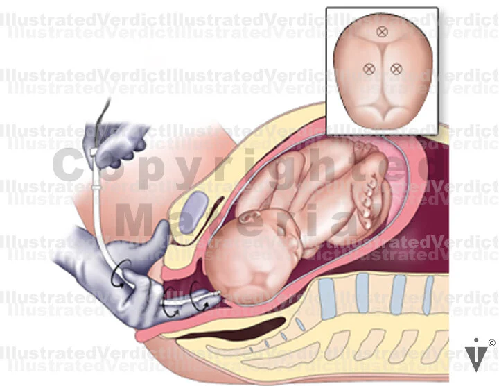 Stock Fetal Strips Fetal Monitoring Illustrations — Illustrated Verdict