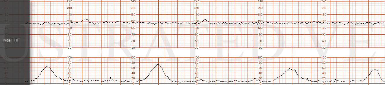 Stock Template Fetal Strips Iv Fetal Strip Library From Courses Illustrated Verdict