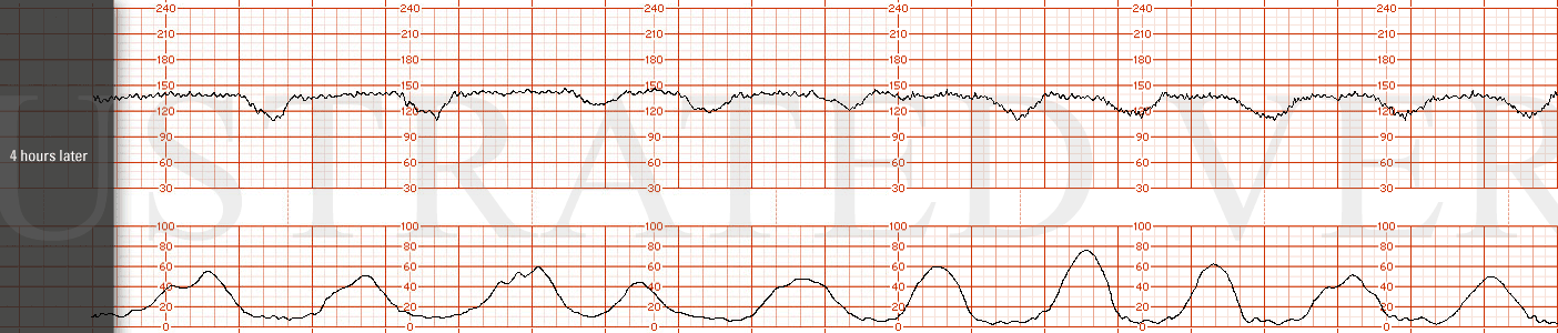 STRIP 2 1. Tracing 4hr later: Baseline 140, minimal variability, recurrent late decelerations with every contraction Ctx q 1-2 min