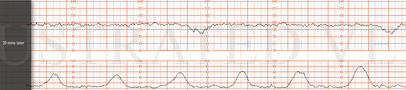 STRIP 3 1. Tracing 30 min later: Baseline 140, moderate variability, intermittent late decelerations (every 3rd contraction), no accelerations Toco q 3 min