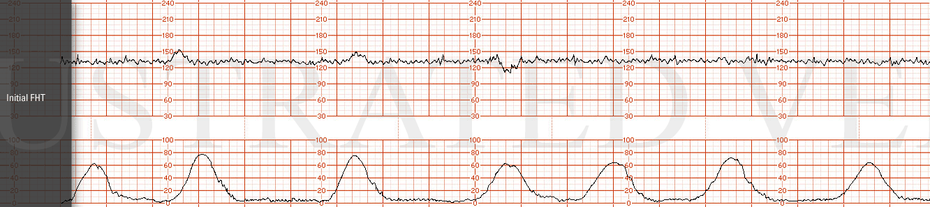 STRIP 4 1. Initial tracing: Baseline 130, moderate variability, accelerations and one variable deceleration (down to 110, lasing 30 seconds) Toco: q 2-3 min