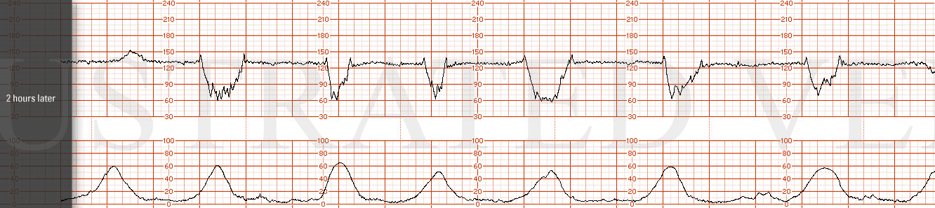STRIP 5 1. Tracing 2 hours later: Baseline 130, minimal variability, one acceleration to 150, then recurrent variable decelerations down to 60 b/min lasting 40-60 sec with "shoulders" before and after decel