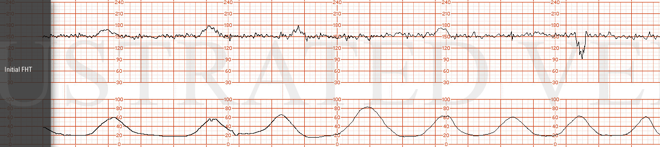 STRIP 6 1. Initial tracing: Baseline 150, moderate variability with accelerations, one variable decel down to 90, lasting 30 sec with ctx Toco: Q2