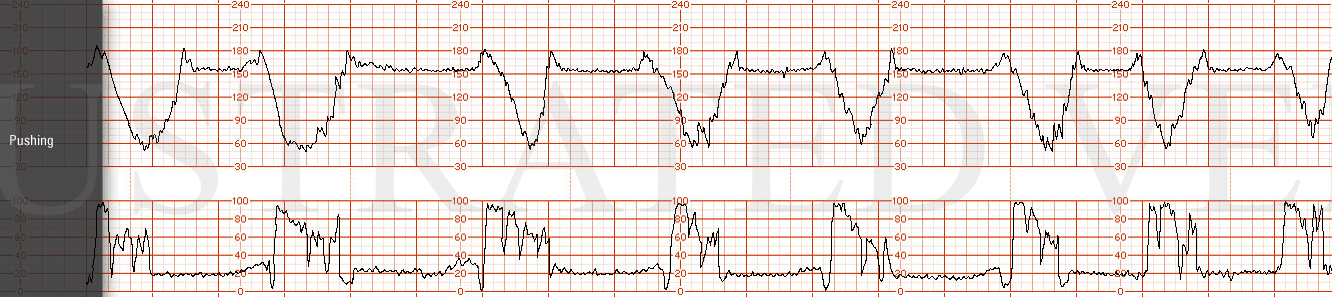 STRIP 7 1. Tracing with pushing: Baseline 155, minimal variability with recurrent variable decelerations down to 50 bmin, lasting 60-80 sec, with "shoulders" to 180 before and after deceleration, occurring with each ctx Toco ctx q 2-3 min with "push…