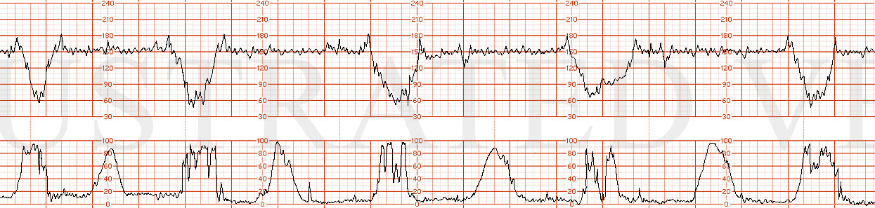STRIP 8 1. Tracing: 150, moder variability, same variable decels as above with pushing, alternating with "mild" variable decels down to 120 x 30 sec without pushing Toco: q 2-3 min, with "pushing" artifact with every other ctx