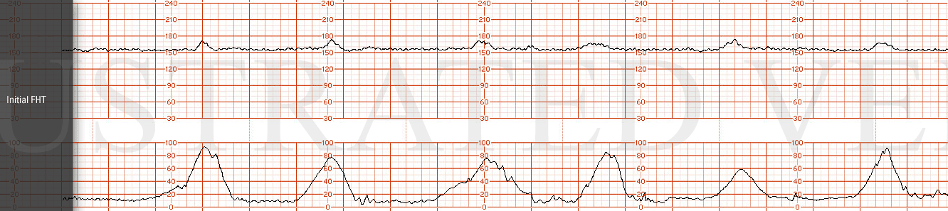 STRIP 9 1. Initial tracing: Baseline: 155 minimal variability with accelerations to 165 with each contraction Toco; q 3 min