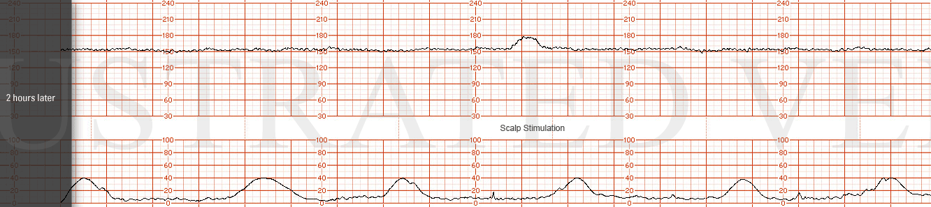 STRIP 10 1. Tracing 2 hrs later: Baseline: 155 minimal variability, one acceleration (with exam/scalp stim), no decelerations Toco: q 3-4 (MVU 100)
