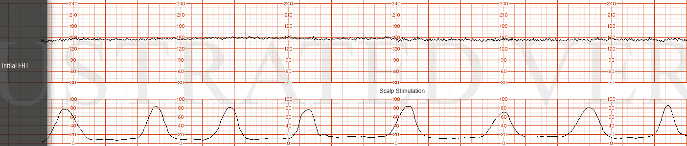 STRIP 11 1. Initial tracing: Baseline 145, minimal variability, no accelerations, no response to scalp stimulation, no decelerations
