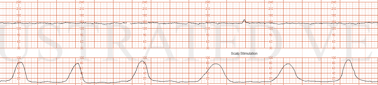 STRIP 12 1. Baseline 145, minimal variability, one acceleration 10x10 b/min (with scalp stim), no decelerations