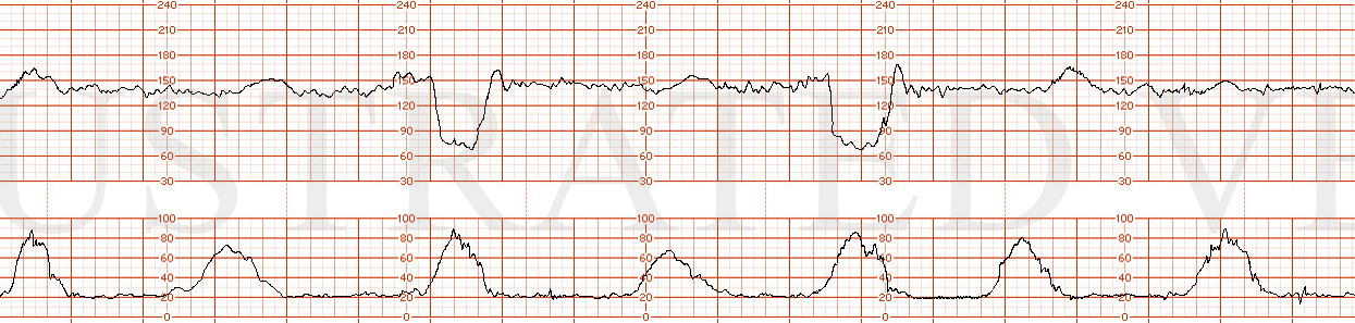 STRIP 21 1. The following fhrt just like strip 20, except with 2 severe variables in a 10 minute window – normal variability and accelerations