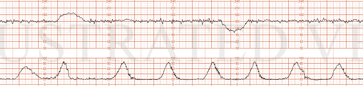 STRIP 22 1. The fhrt is as follows: (baseline hr 150 bpm, normal variability, one acceleration. 1 classic late deceleration is seen in a series of 5 contractions occurring over a 10 minute window. (the late decelerations are too deep (some are nadir…