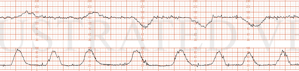 STRIP 23 1. The following fhrt is observed (same tracing as above, strip 22, with 2 accelerations, but classic late decelerations in 3 of 5 contractions over a 10 minute window.)