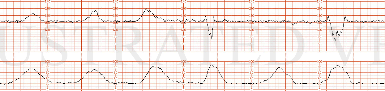 STRIP 24 1. The following fhrt is seen a fhrt with the following features: baseline 155 bpm, normal variability, 3 prominent accelerations, 1variable deceleration to 80 bpm lasting only 30 seconds from baseline to baseline , and 1 variable decelerat…