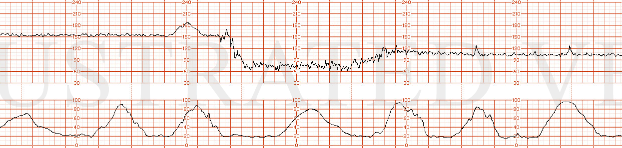 STRIP 25 1. the following fhrt For the first 7 minutes, the baseline is stable at 155 bpm, normal variability and 1 acceleration. There is then a 4 minute bradycardia to 60 bpm with recovery over 1 minute to a baseline of 105-110 bpm. Over the next …