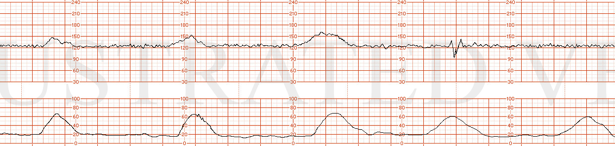 STRIP 26 1. a fhrt with baseline 125 bpm, normal variability, 3 accelerations in a 20 minute window and 5 total contractions in 20 minutes. 1 very small variable deceleration