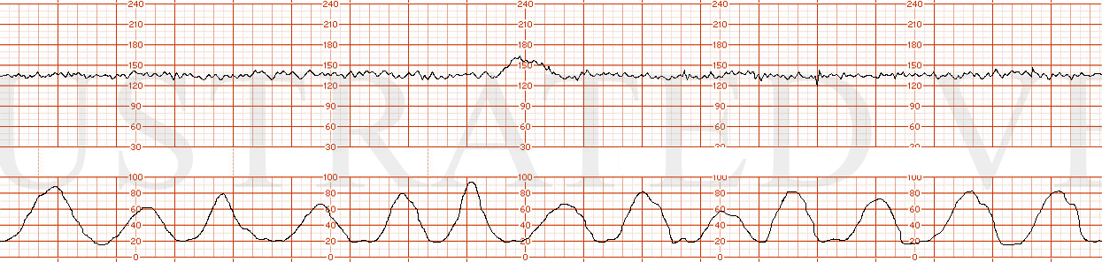 STRIP 27 1. the following fhrt (baseline 135 bpm, normal variability, no decelerations, 1 acceleration in 20 minutes, 13 contractions in 20 minutes