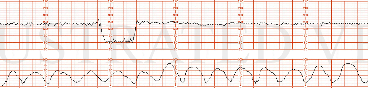 STRIP 29 1. the following fhrt: No change in the initial category I admission fhrt for the first 5 minutes Then a single 2 minutes variable looking decelaration to 60 bpm with prompt recovery Then 10 minutes of category I fhrt uterine contraction oc…