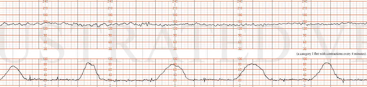 STRIP 30 1. The FHRT is as follows: a category I fhrt with contractions every 4 minutes