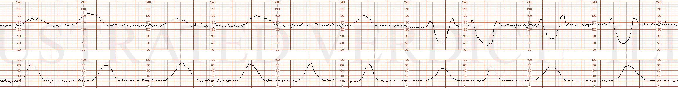 STRIP 31 1. baseline 140 bpm, normal variability, several clear accelerations, 4 severe variable decelerations in 30 minutes with prompt return to baseline