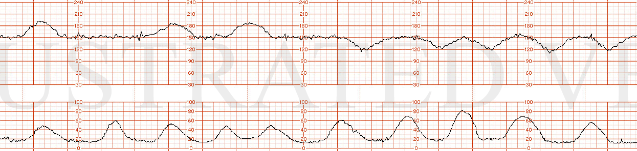 STRIP 32 1. baseline 150 bpm, normal variability, 3 clear accelerations in 10 minutes, 5 contractions in 10 minutes, each with a classic late deceleration