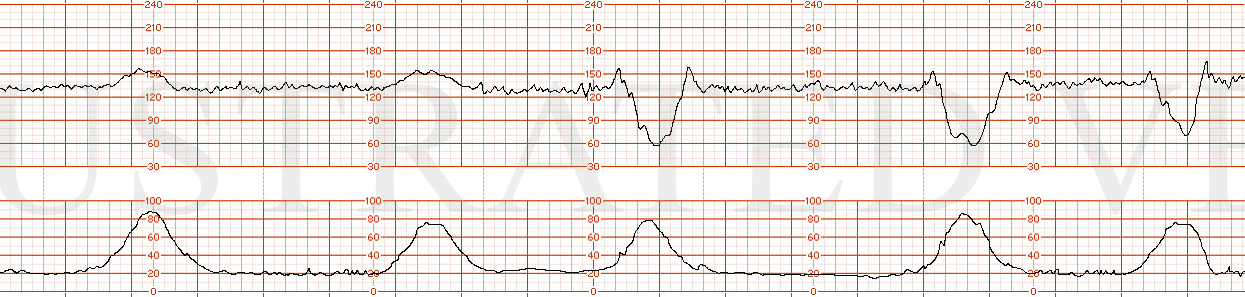 STRIP 33 1. fhrt shows baseline of 130 bpm, normal variability, accelerations, 3 severe variable decelerations in 15 minutes