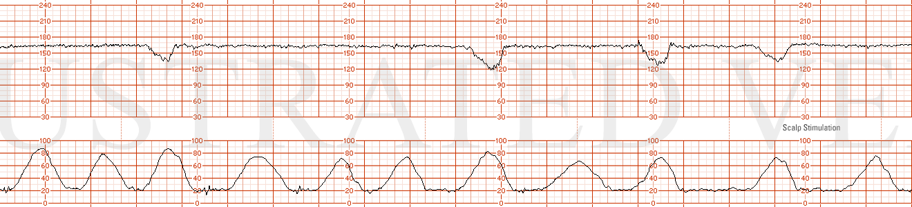 STRIP 35 1. Contractions:11 in 20 minutes, each lasting +/- 50-55 seconds.  Baseline +/- 165 bpm with minimal variability Four mild to moderate, (but not unusual variable decelerations down to range of 105 to 125 bpm at minute 4, 11, 17 minutes, eac…