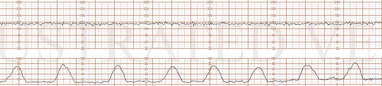 STRIP 38 Contractions – average of 4 contractions / 10 minutes each symmetric x 60 seconds Baseline 1 – 145 with average variability Decelerations - none Accelerations – none