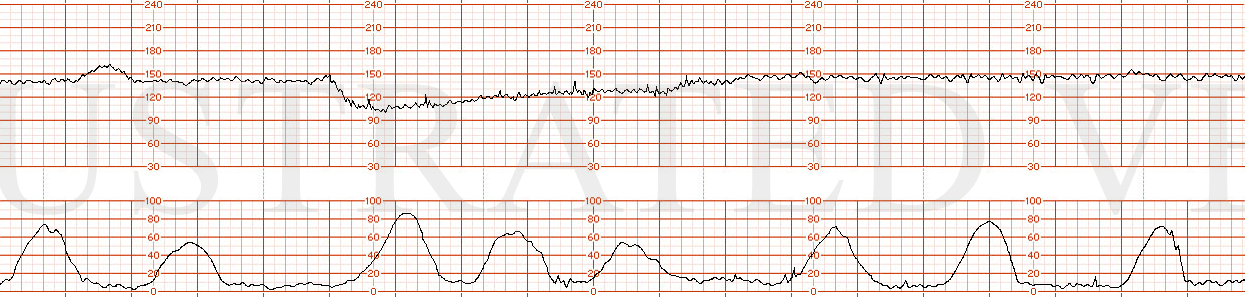 STRIP 40 1. Contractions: 7-8 60-70 second contractions in 20 min. See exception  below re deceleration associated contractions – 3 run together concluding 30 sec or so before end of deceleration. Baseline 140 bpm for first 5 minutes w 7-8 bpm varia…