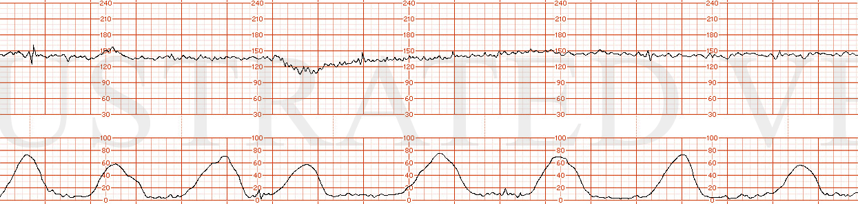 STRIP 41 1. Contractions: 7-8 60-70 second contractions in 20 min. Contractions at  more predictable intervals with no coupling or tripling of contractions Baseline 140 bpm for first 6 minutes Decelerations One deceleration x 6 minutes to initial na…