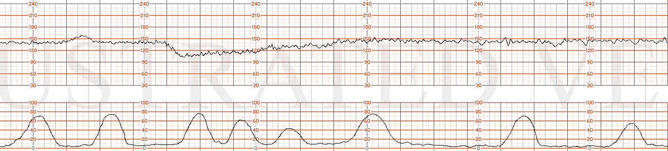 STRIP 42 1. Contractions: 7-8 60-70 second contractions in 20 min. See exception  below re deceleration associated contractions – 3 run together concluding 30 sec or so before end of deceleration. Baseline 140 bpm for first 5 minutes w 7-8 bpm varia…