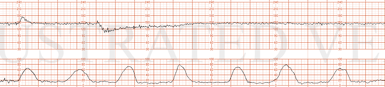 STRIP 43 1. Contractions: 7-8 60-70 second contractions in 20 min. Contractions at  more predictable intervals with no coupling or tripling of contractions Baseline 145 bpm for first 5 minutes Decelerations One deceleration x 6 minutes to initial na…
