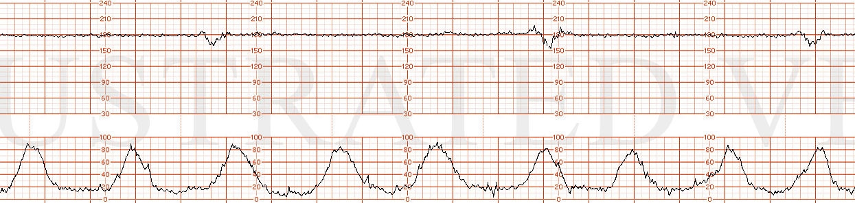 STRIP 44 1. Ctxs 8 in 18 or 9 in 20 min, each 60 sec Baseline 180 bpm with minimal variability at 2-3 bpm Decels – 30 second variable decels to 160, 155, 160 bpm nadir each with prompt return to baseline with one of three contractions Accels- None