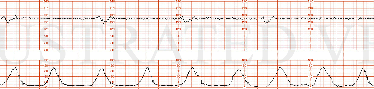 STRIP 45 1. Ctxs -8 in 18 or 9 in 20 mins, each 60 seconds Baseline – 165 bpm w minimum variability at 3-4 bpm Decels – 30 sec variable decels to 140,145,150,145 bpm nadirs, each with prompt return to baseline with one for each two-three contraction…
