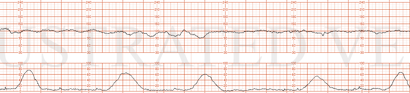 STRIP 46 1. Ctxs1 – every 4-5 minutes Baseline1 – 120 bpm  Decels1 - ? Baseline undulations vs ? late decels - with minimal (possibly absent) variability. Lates responsive to IU Resuscitation Variability1 – minimal /possibly absent Accels1 - none