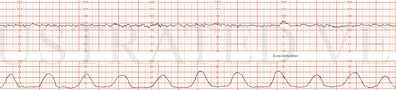 STRIP 48 1. Ctxs – 11 contractions each 50 sec 55 sec 50 sec, etc duration Baseline -140bpm with mod variability -7-8 bpm Decels - None Accels – None until scalp stimulation to be written on strip done at 14 min into strip – 18 bpm x 20 sec