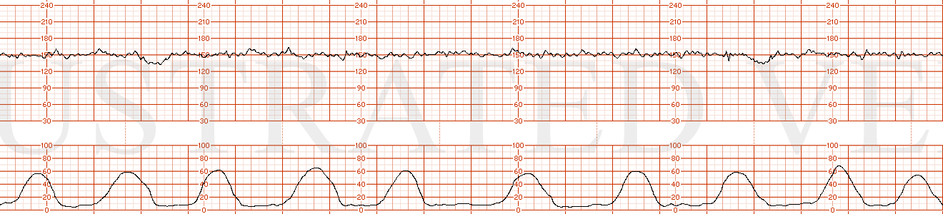 STRIP 49 1. Ctxs – 10 contractions – each 60, 65, 60, 65 etc sec duration. Baseline – 150 bpm with mod variability 7-8 bpm Decels - Late Decel with Ctx 2, Ctx 8, each 15 bpm nadir Variability – moderate at 7-8 bpm Accels – none scalp stim not done