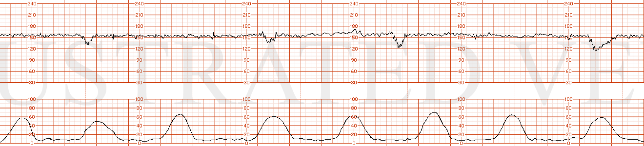 STRIP 50 1. Ctxs – 8 contractions – as above strip 2 Baseline 155 bpm with min-mod variability varying 4-6 bpm transitioning every 6 minutes or so from 4 to 6 to 4 bpm Decels – Variable decelerations at CTX 2, 4, 6, 8, - of 30 sec, 40 sec, 35 sec an…