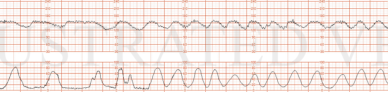 STRIP 51 1. Spontaneous tachysystole Recurrent late decelerations Moderate variability Baseline 155