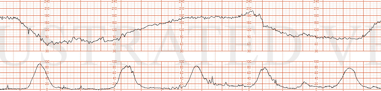 STRIP 52 1. 2 Recurrent prolonged decelerations  Moderate variability Baseline 170