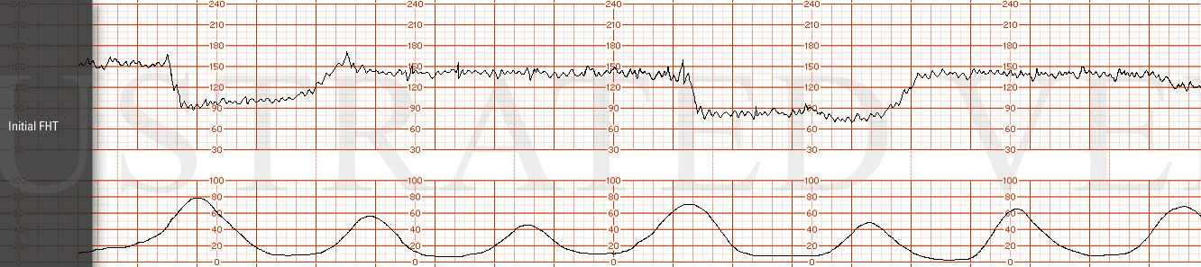 STRIP 53 1. Category II tracing with prolonged variable decelerations, variability remaining moderate