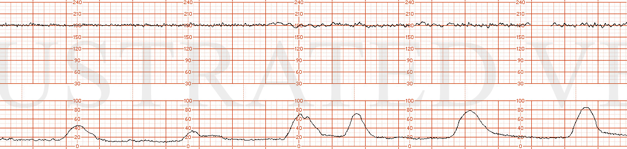 STRIP 55 1. FHR 180 Minimal to moderate variability No decelerations