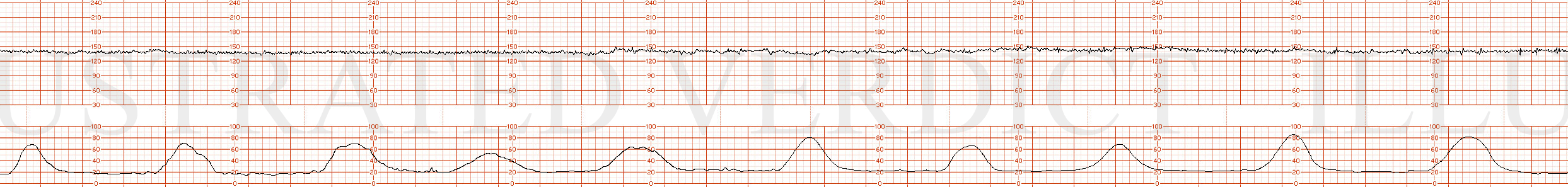 STRIP 56 1. Minimal variability No accelerations for 40 minutes No decelerations