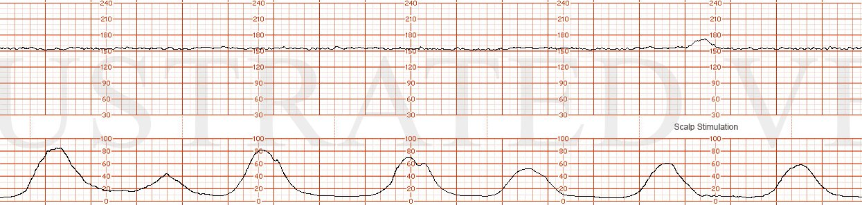STRIP 57 1. FHR 155  Minimal variability No decelerations Regular contractions