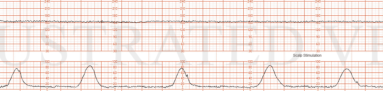 STRIP 58 1. FHR 155  Minimal variability No decelerations